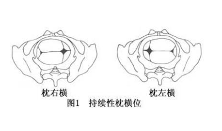 枕横位的原因和影响