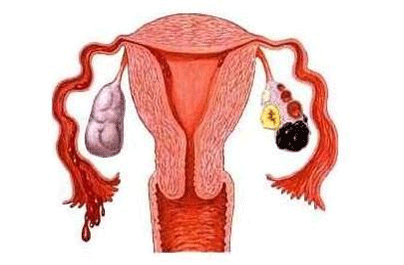 卵巢囊肿不手术行吗