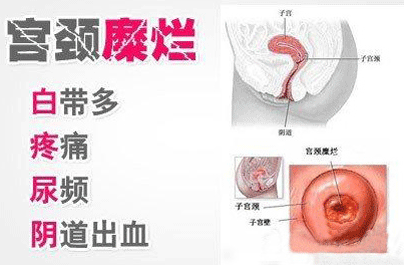 重度宫颈糜烂的症状