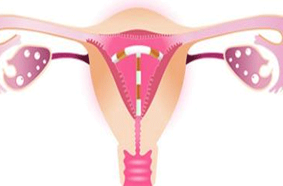 节育环移位的原因