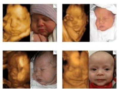 孕妇三维彩超查什么