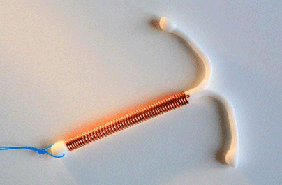 宫内环移位有什么症状