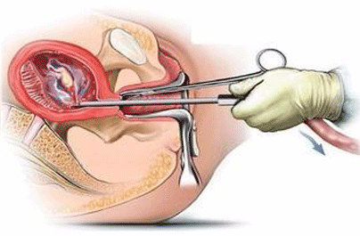 可视人工流产的费用
