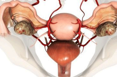 双侧卵巢囊肿严重吗