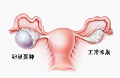 双侧卵巢囊肿怎么办